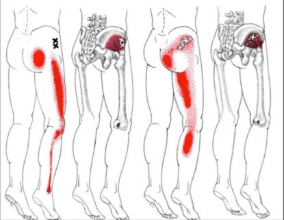 Signs You May Have Sciatic Nerve Decay