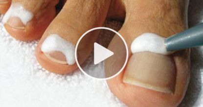 If You Have Toenail Fungus Try This Tonight (Genius)