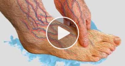 Fighting Neuropathy? Try This Immediately