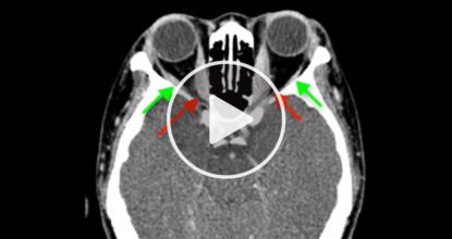 This Natural Navajo Remedy Restores Crystal-Clear 20/20 Vision