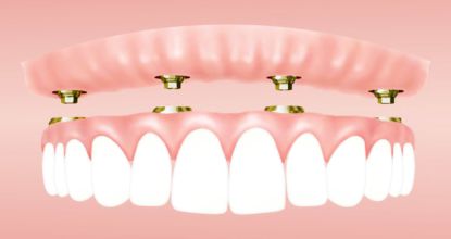 Here's What Same-Day Dental Implants Should Cost