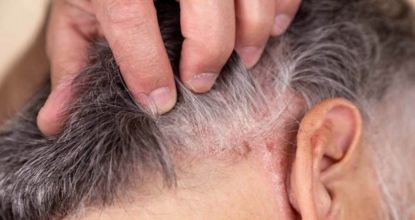 Try Not To Scratch! How To Treat Scalp Psoriasis