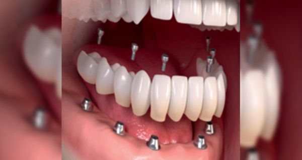 Many Seniors Are Getting Permanent Teeth With This - See Prices
