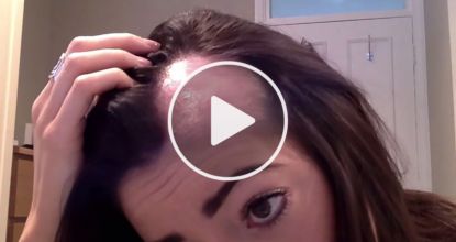 Hair Falling Out In Bunches? Use THIS Mineral On Bald Spots