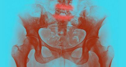 How Your Body Warns You That Sciatica Is Forming