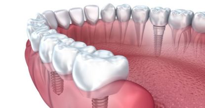 See If You Qualify For Government Dental Implant Grants