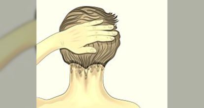 What Is Scalp Psoriasis? Symptoms, Causes & Treatments