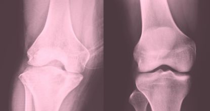 Bone On Bone Knees? Top Arthritis Doc Says Do THIS 2x A Day