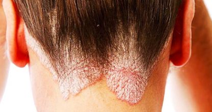 What Is Plaque Psoriasis? Symptoms, Causes & Treatments